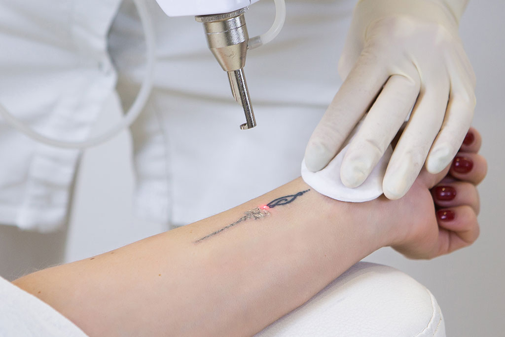 Pico-laser behandeling tatoeage verwijderen
