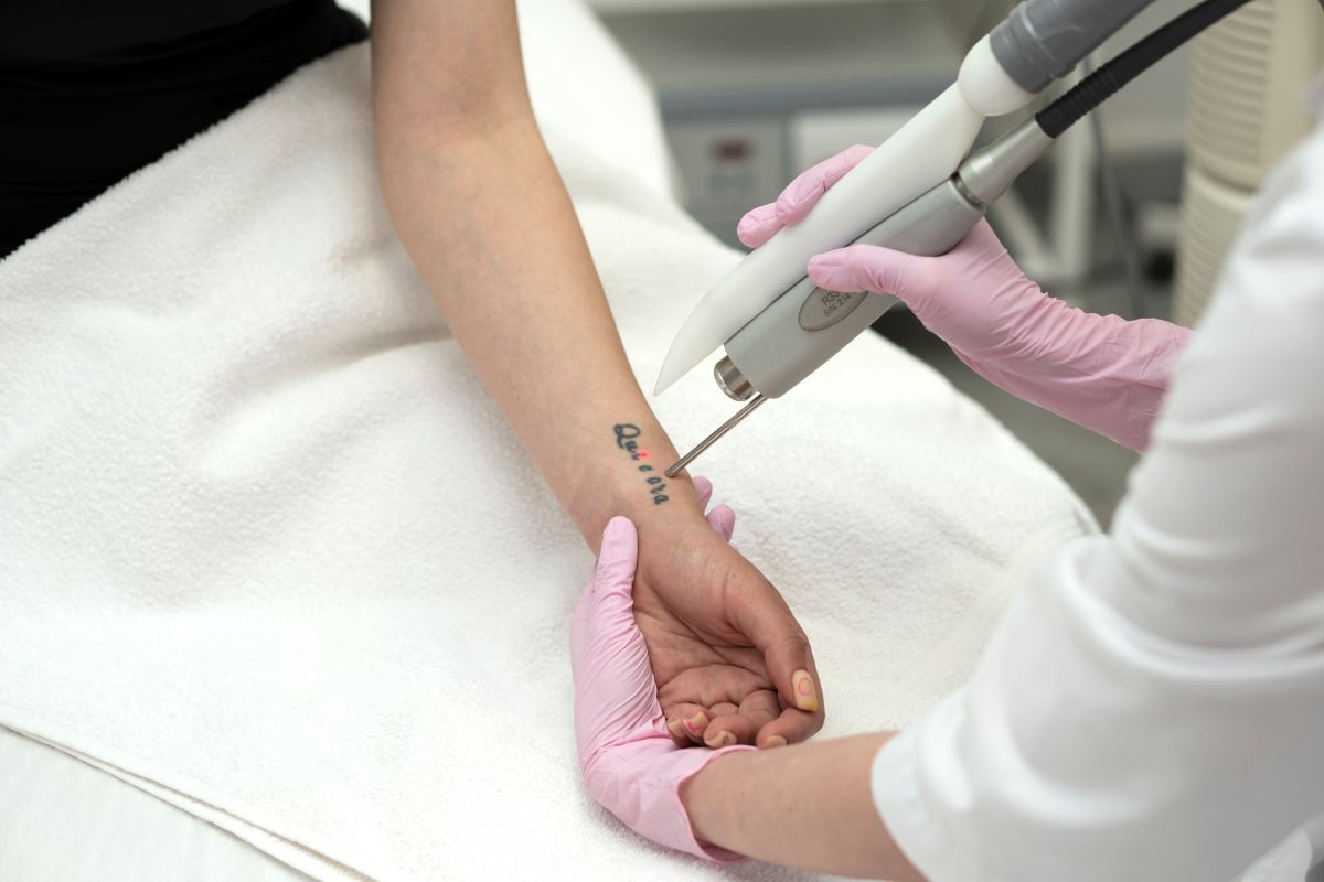 Pico-laser behandeling tatoeage verwijderen